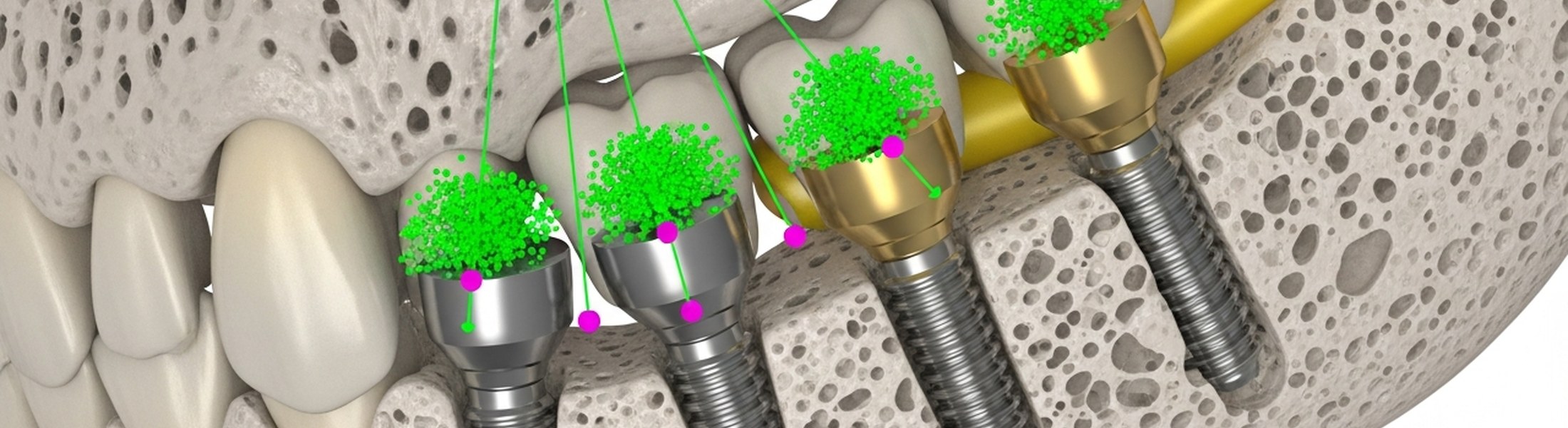 3D-Planung einer Implantatbohrschablone am Oberkiefer