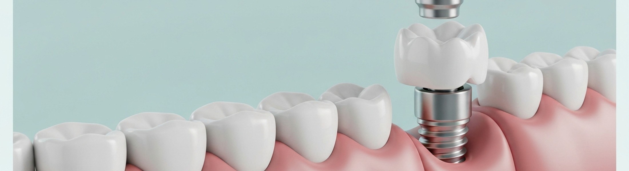 Illustration einer implantatgetragenen Einzelzahnkrone
